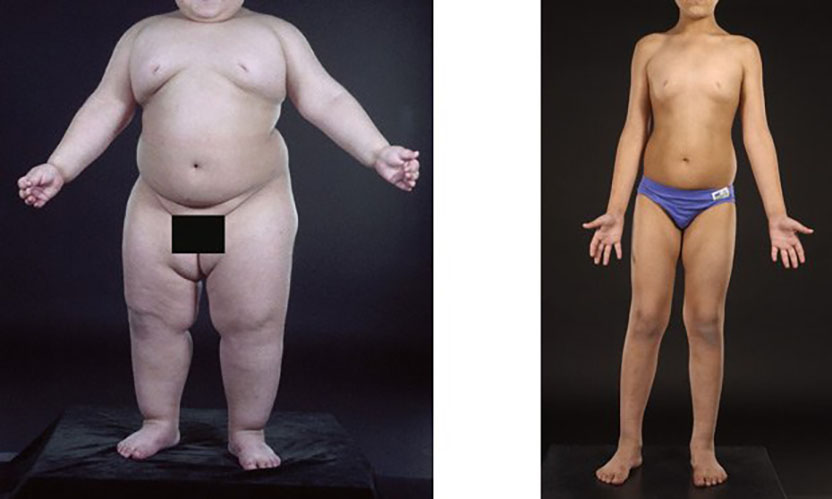 Enlightened treatment. Daily injections of leptin dramatically reduced appetite and weight in a child with leptin deficiency. At three years old (left), this boy was morbidly obese; at seven years old (right), he was in the 75th percentile for weight. (Courtesy of Stephen O'Rahilly and Sadaf Farooqi, with permission of the child's parents.)