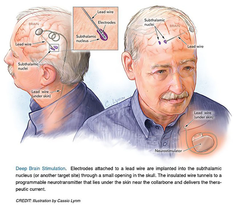 Illustration of electrodes attached to a brain