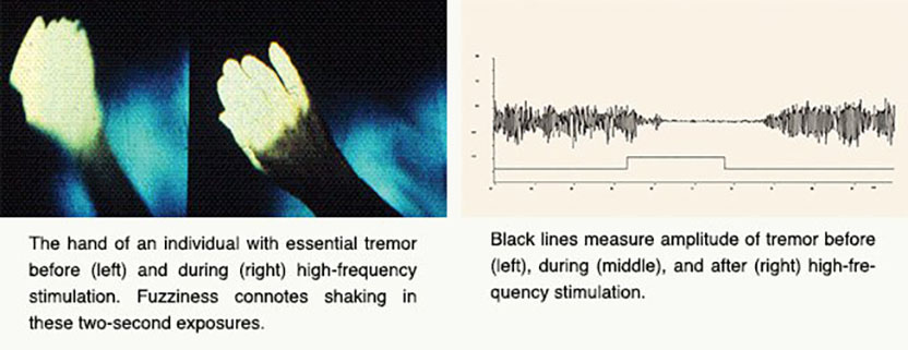 brain waves associated with hand tremors