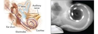 cochlear implant illustration