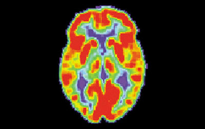 PET scan