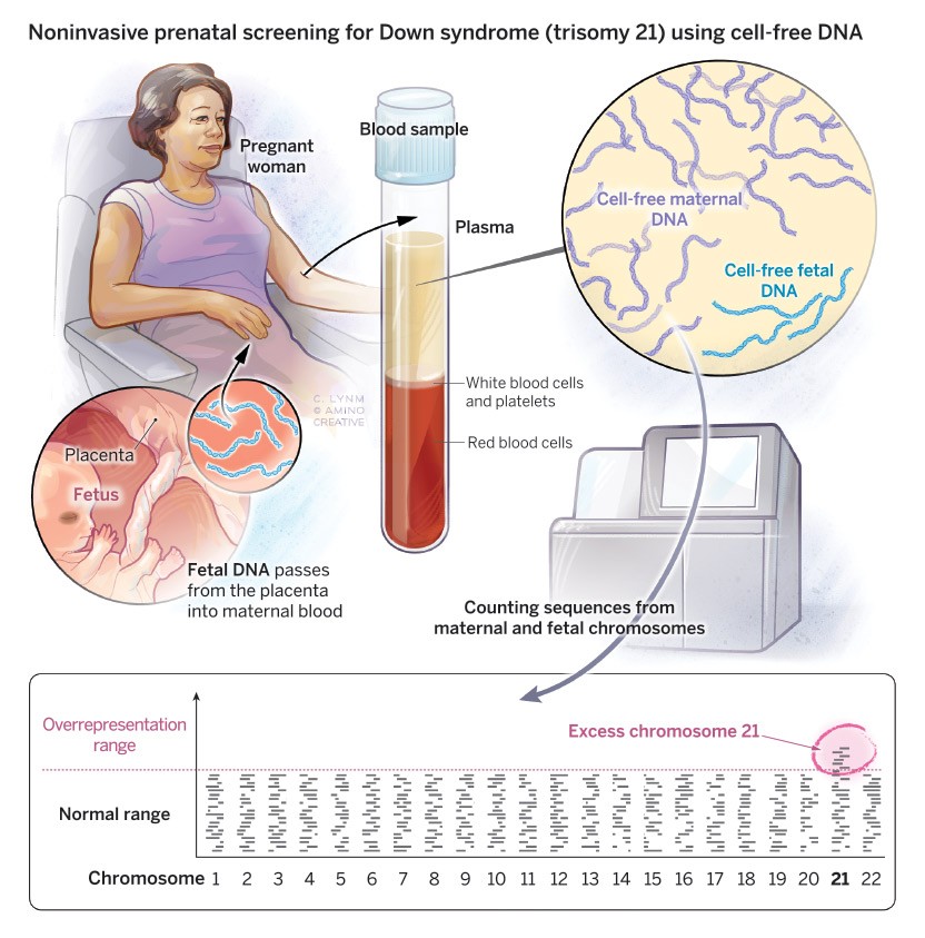 Non-invasive prenatal screening for Down syndrome