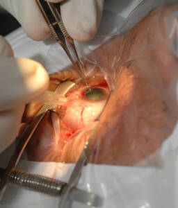 cataract surgery